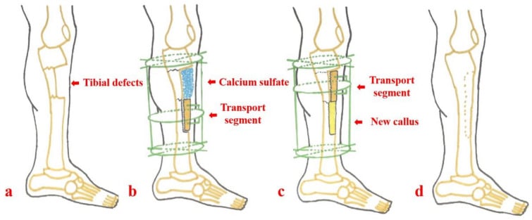 Four-stage schematic of semi-focal transport for a semicylindrical tibial defect.
