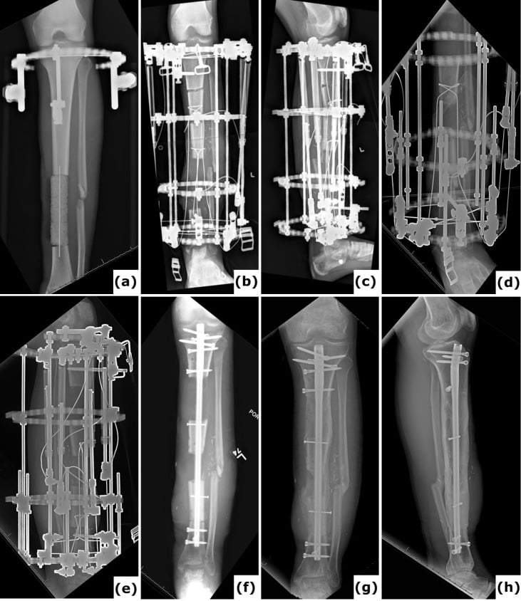 Serial radiographs of trifocal balanced cable transport followed by intramedullary nailing for a twelve-centimetre tibial defect.