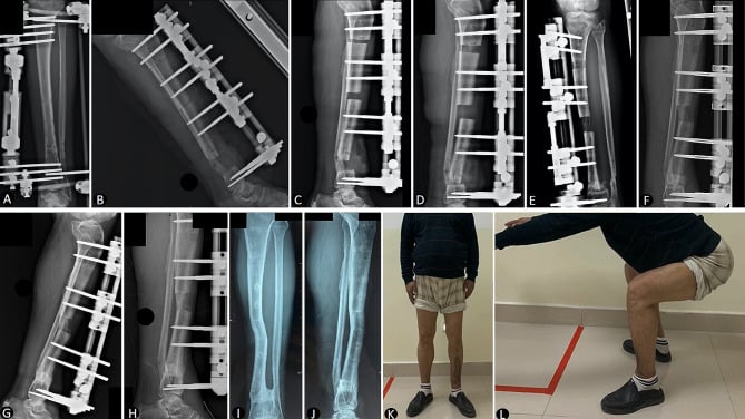 Clinical and radiographic series of trifocal tibial bone transport after resection of infected distal tibia.