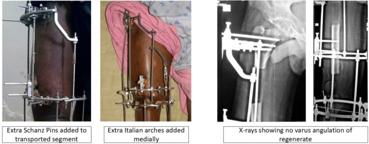 Clinical photographs and radiographs showing added Schanz pins and medial arches to prevent varus angulation during transport.