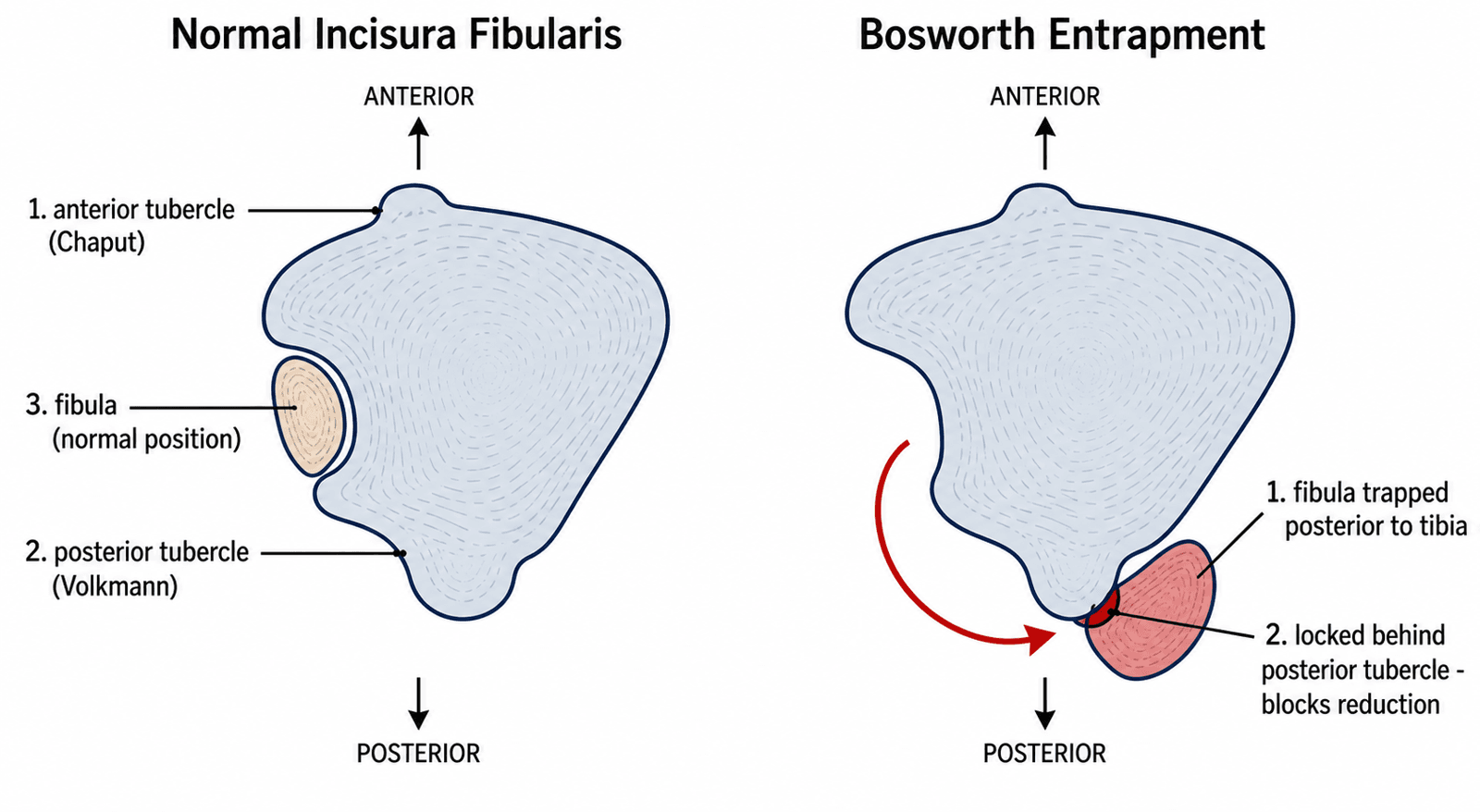 Axial schematic comparing the normal incisura fibularis, with the fibula seated between the anterior (Chaput) and posterior (Volkmann) tubercles, to the Bosworth entrapment, with the fibula rotated posteriorly and locked behind the posterior tubercle.