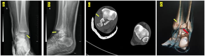 Bosworth fracture-dislocation imaging showing axilla sign on AP X-ray, posterior talus subluxation on lateral X-ray, and fibula trapped behind tibia on axial CT