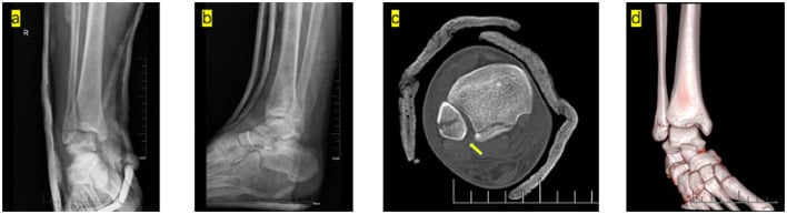 Post-reduction imaging of Bosworth fracture showing restored ankle mortise alignment