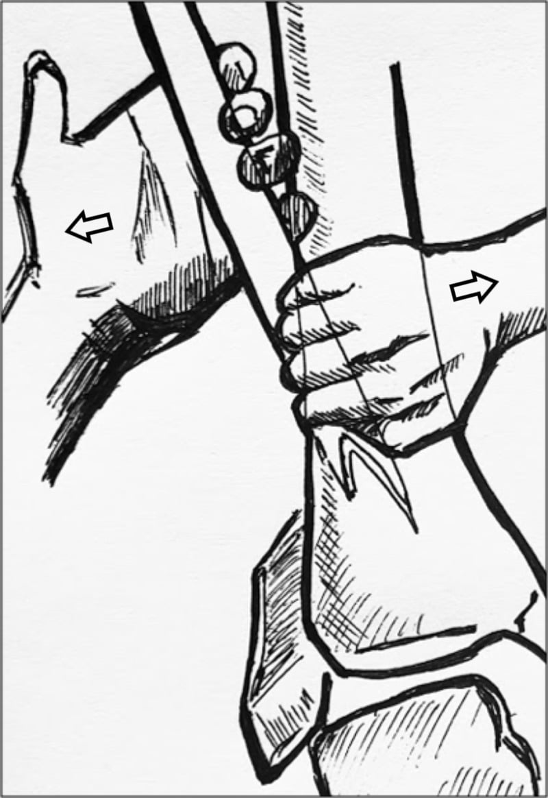 Author-drawn Bosworth closed reduction manoeuvre, a hand gripping the leg with open arrows marking opposing directions of force