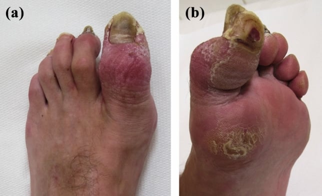 Forefoot deformity and pressure lesions three months after compartment syndrome complicating a Bosworth injury