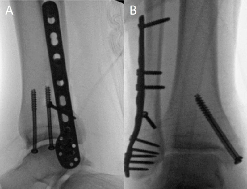AP and lateral fluoroscopic images showing definitive fixation after Bosworth reduction