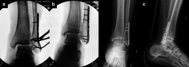 Intraoperative fluoroscopy and postoperative radiographs during fixation of a Bosworth fracture-dislocation