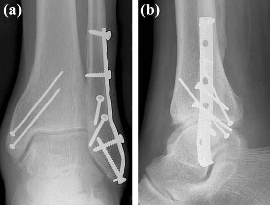 AP and lateral ankle radiographs after complex fixation of a Bosworth fracture complicated by compartment syndrome