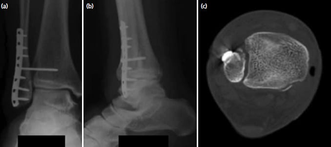 Postoperative AP and lateral radiographs with axial CT showing the fibula seated in the incisura after Bosworth fixation