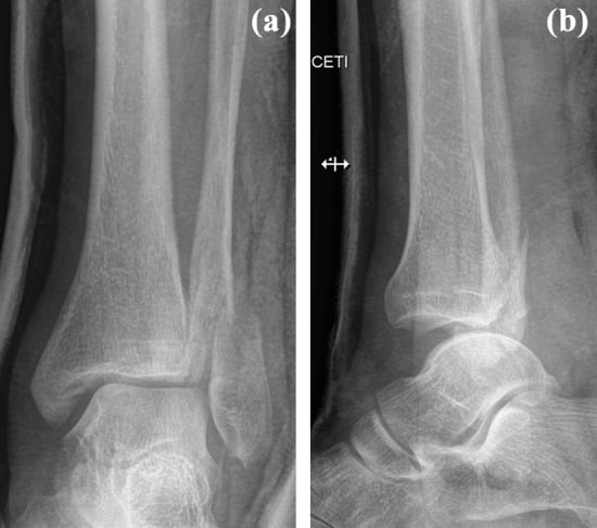 AP and lateral ankle radiographs showing distal tibiofibular overlap and posterior tibiofibular dissociation in a Bosworth injury