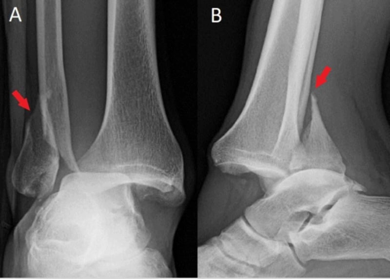 AP and lateral ankle radiographs showing a Bosworth fracture-dislocation with the fibula displaced posterior to the tibia
