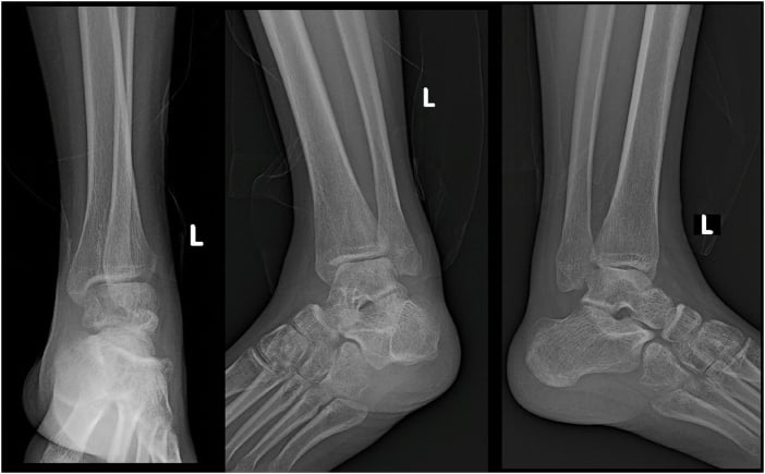 AP, oblique and lateral radiographs showing a neglected pure Bosworth dislocation without a fibular fracture