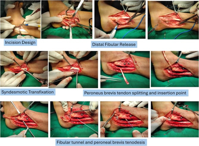 Operative sequence showing distal fibular release, syndesmotic transfixation and split peroneus brevis augmentation in a neglected Bosworth dislocation