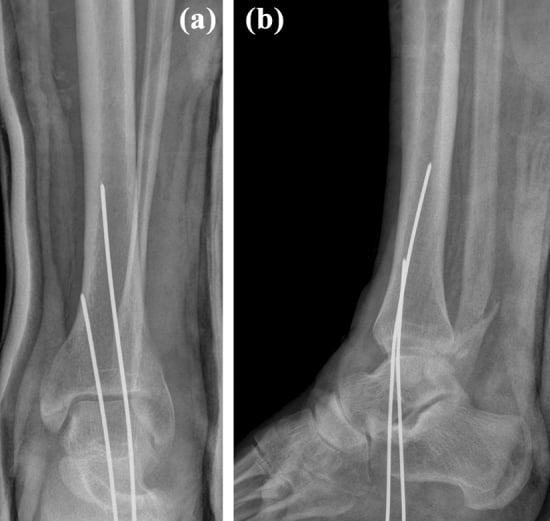 AP and lateral ankle radiographs showing persistent overlap and posterior tibiofibular dissociation after unsuccessful reduction