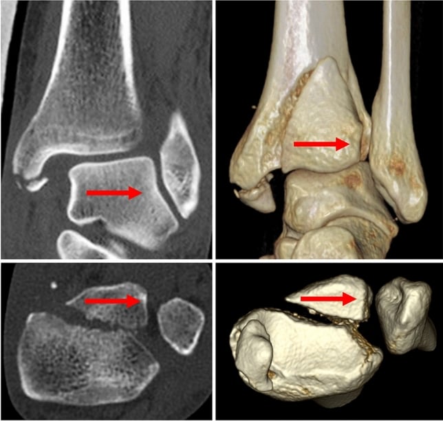 Coronal and axial CT with 3D reconstructions showing lateral displacement of a posterior malleolar fragment with the distal fibula