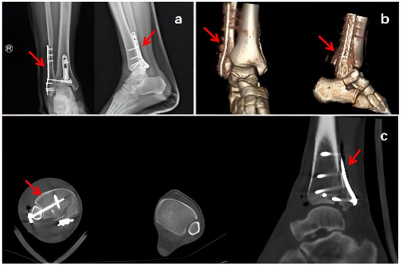Postoperative radiographs, 3D CT and multiplanar CT after fixation of a Bosworth fracture-dislocation