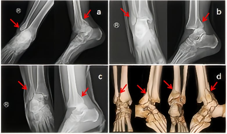 Serial ankle radiographs after two failed reductions with 3D CT showing persistent Bosworth entrapment