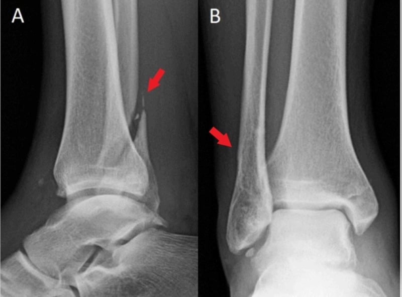 Lateral and AP ankle radiographs after successful closed reduction of a Bosworth fracture-dislocation