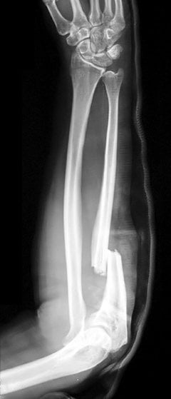 Lateral radiograph showing Monteggia fracture of right forearm with proximal ulna fracture and anterior radial head dislocation