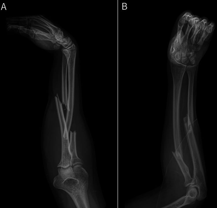 Lateral and AP radiographs of a displaced proximal-third radius and midshaft ulna fracture associated with progressive anterior interosseous nerve palsy