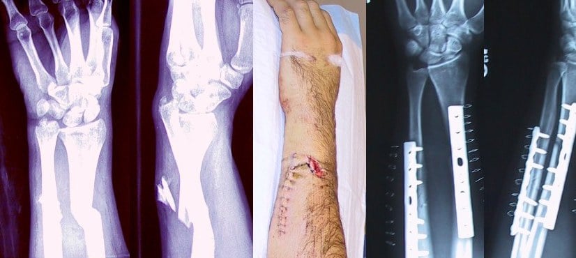 Post-operative radiograph showing ORIF of both-bone forearm fracture with 3.5mm plates on radius and ulna in orthogonal orientation