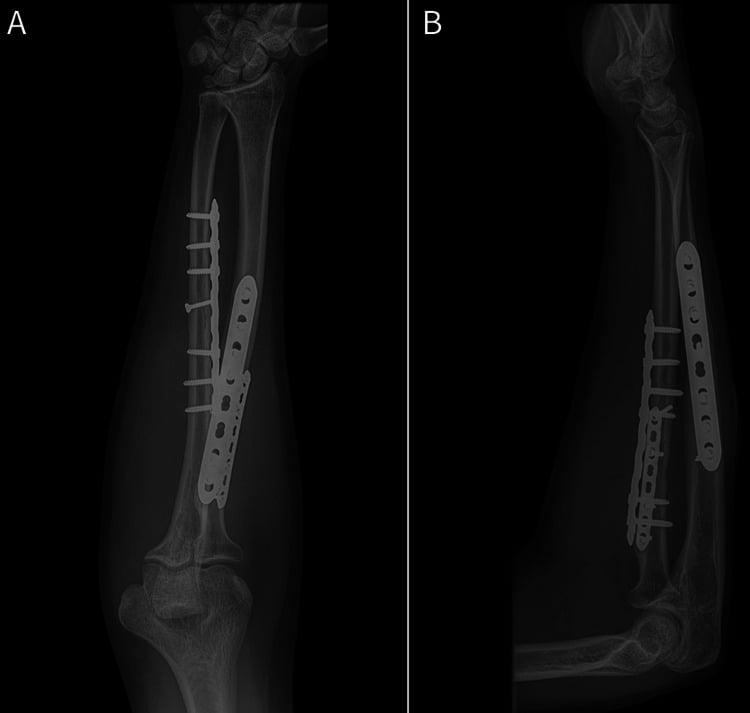 AP and lateral forearm radiographs at twelve weeks showing union after plate fixation of a proximal radius and ulna fracture