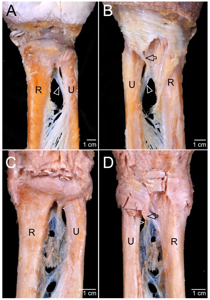 Four cadaveric distal forearm dissections showing the radius, ulna, distal interosseous membrane and distal oblique bundle variants near the DRUJ