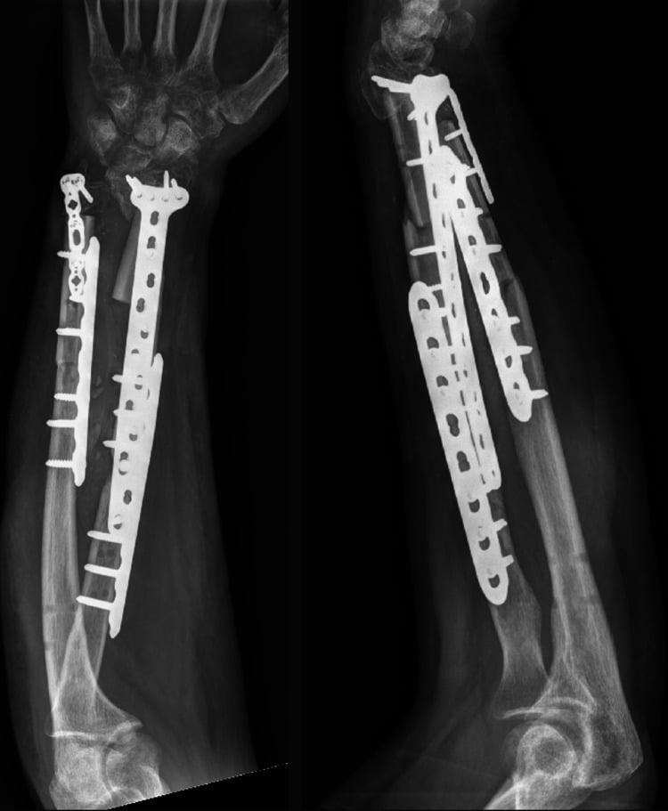 AP and lateral radiographs after staged reconstruction of severe adult both-bone forearm bone loss with long plates and structural fibular allografts