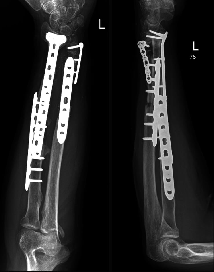 One-year AP and lateral radiographs showing union of a severe both-bone forearm defect reconstructed with plates and fibular allografts