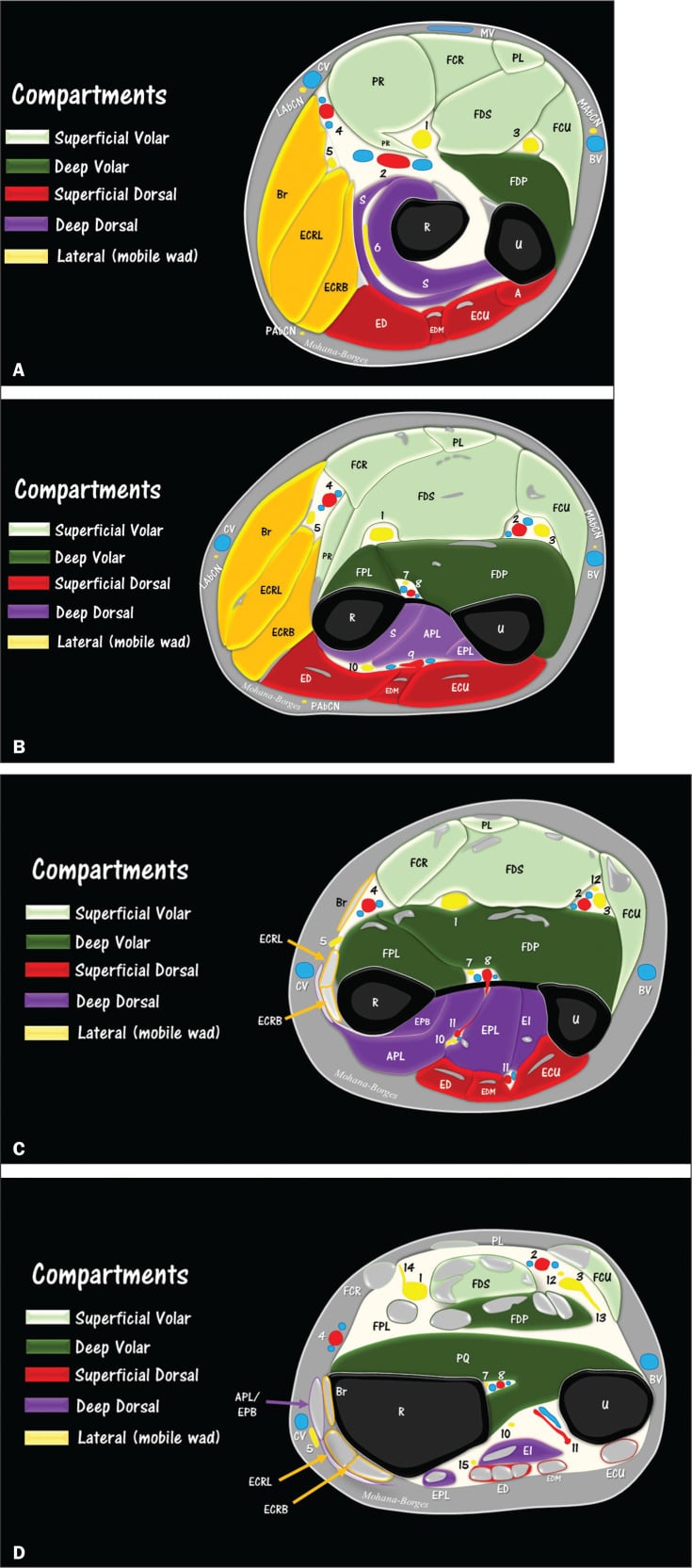 Four axial diagrams of the proximal-to-distal forearm showing superficial and deep volar, superficial and deep dorsal, and mobile-wad compartments around the radius and ulna