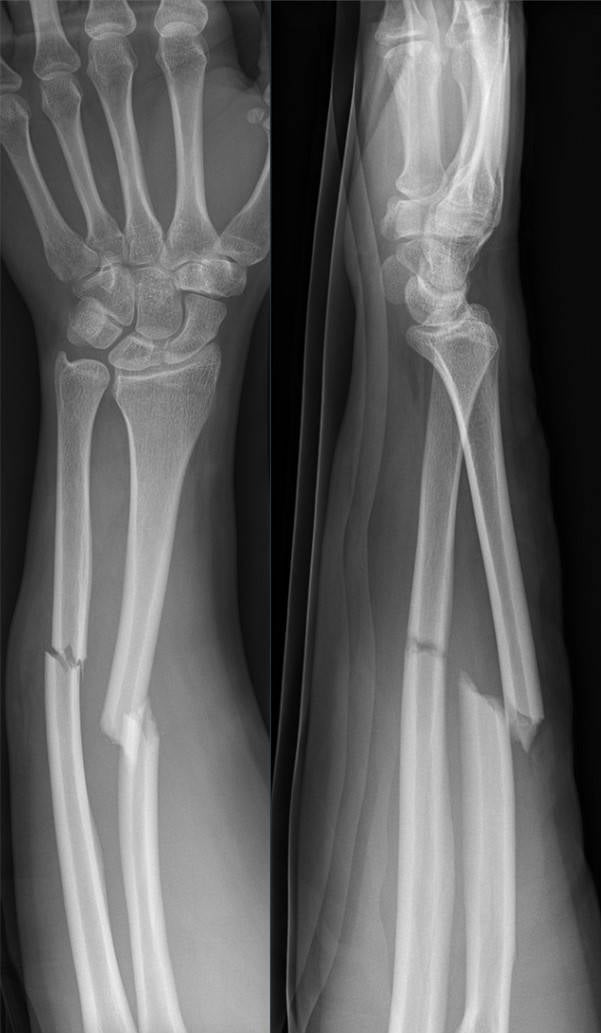 AP and lateral radiographs showing displaced forearm shaft fracture with significant radial displacement from direct trauma in a 22-year-old male