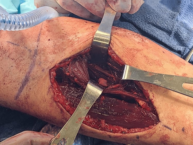 Close surgical operative view after pronator-tunnel decompression showing the AIN in continuity between retracted pronator teres and flexor digitorum superficialis