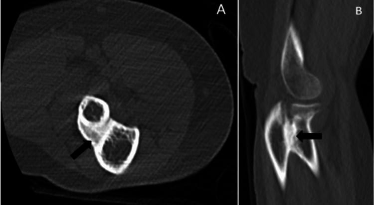 Axial and sagittal CT images showing a two-centimetre proximal radioulnar synostosis at the PRUJ