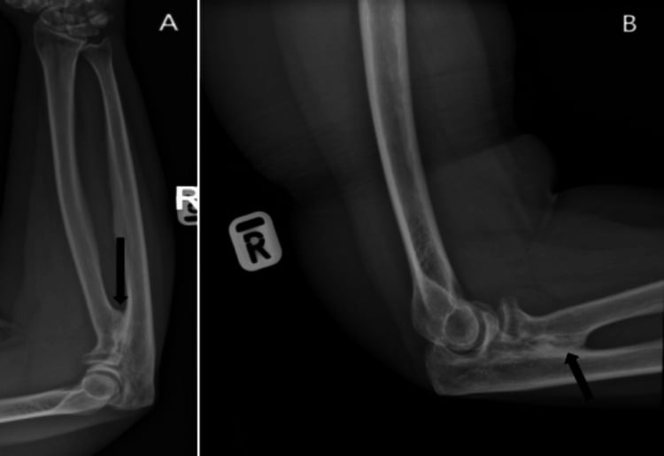 AP forearm and lateral elbow radiographs showing a proximal radioulnar bony bridge marked by arrows