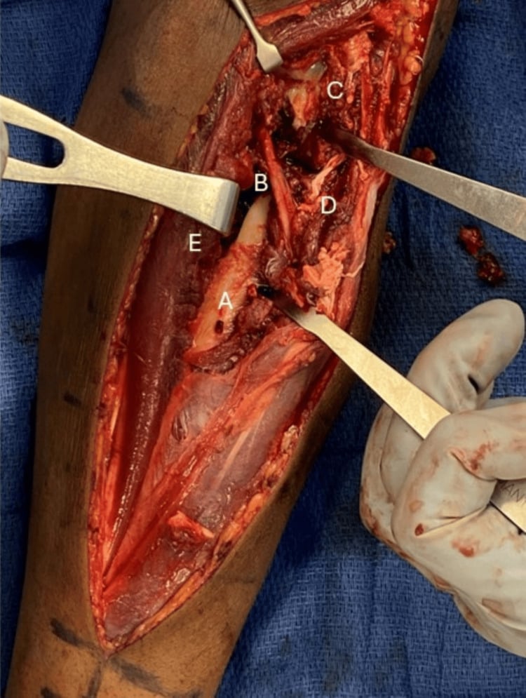 Draped dorsal Thompson exposure of the proximal radius with labels identifying radial shaft, PIN, radial head-neck segment, supinator and ECRB
