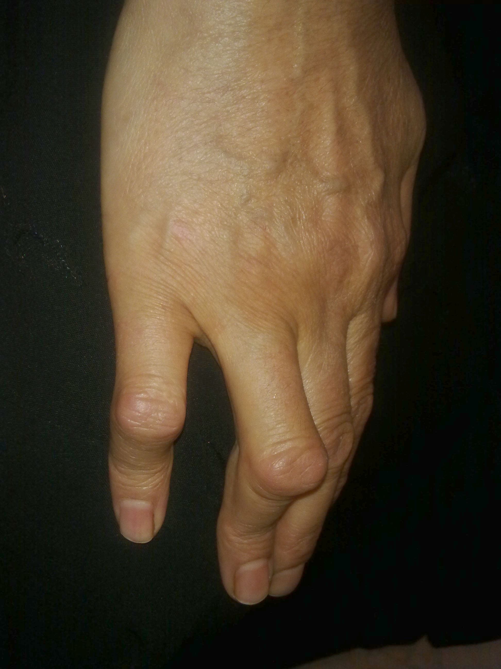 Clinical photograph of boutonnière deformity: PIP flexion with DIP hyperextension; lateral radiographic imaging is used to exclude a bony central-slip avulsion.