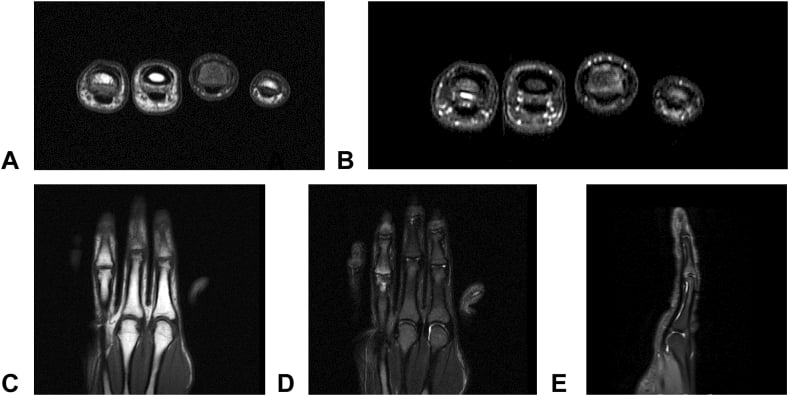 Multiplanar finger MRI showing continuity of dorsal central-slip and volar-plate avulsion fragments.