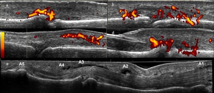 Dorsal longitudinal ultrasound montage showing the finger extensor central-slip insertion at the middle phalanx.