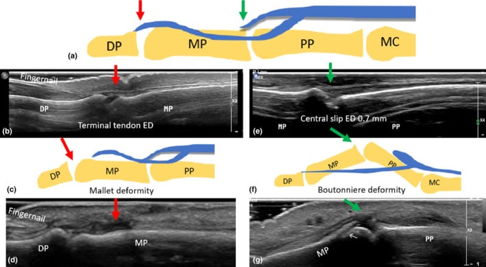 Diagram and longitudinal ultrasound comparing an intact central slip with a torn central slip producing boutonniere deformity.