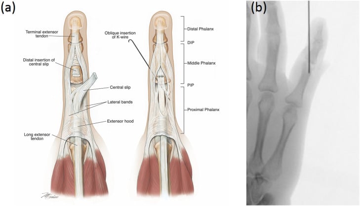Illustration of central-slip repair with trans-articular PIP K-wire protection beside a postoperative radiograph.