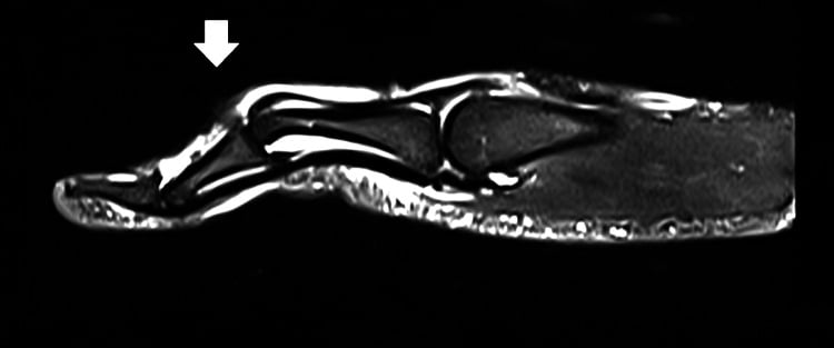 Sagittal finger MRI showing a central-slip tear and boutonniere deformity at the PIP joint.