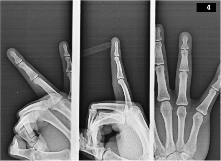 AP, oblique and lateral finger radiographs showing dorsal central-slip and volar-plate avulsion fragments.