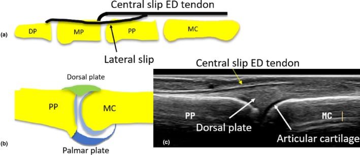 Diagrams and ultrasound of the finger extensor tendon trifurcating into a central slip and paired lateral slips.