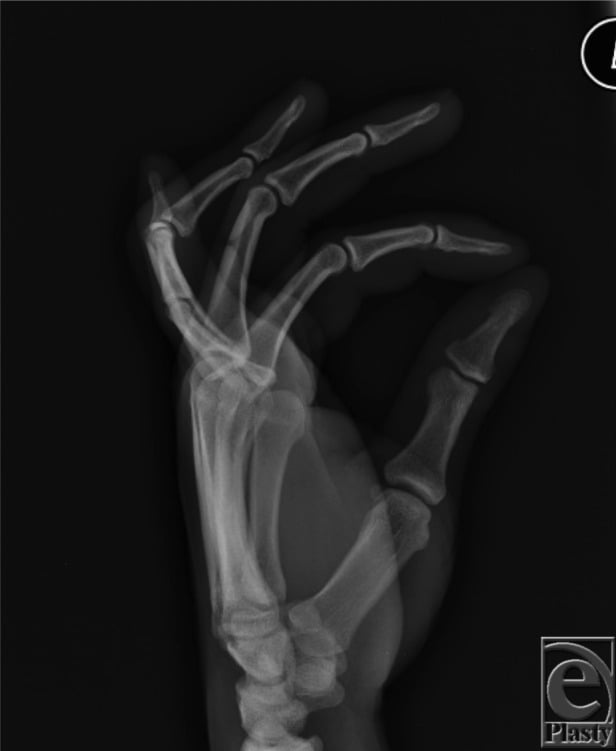 Lateral hand radiograph showing PIP flexion and DIP hyperextension in established boutonniere deformity.