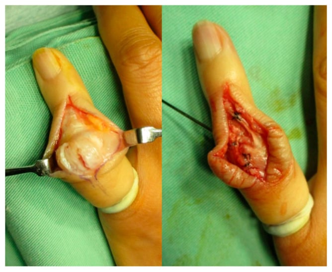 Two intraoperative photographs showing Matev lateral-band reconstruction for chronic boutonniere deformity.