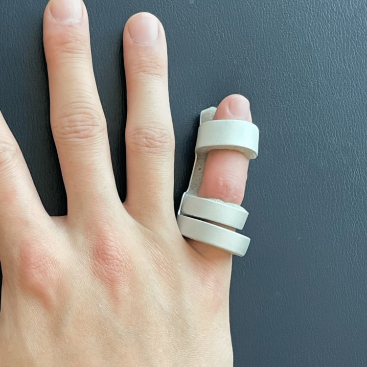 Clinical photograph of a finger orthosis holding the PIP joint in extension while leaving the DIP joint free.