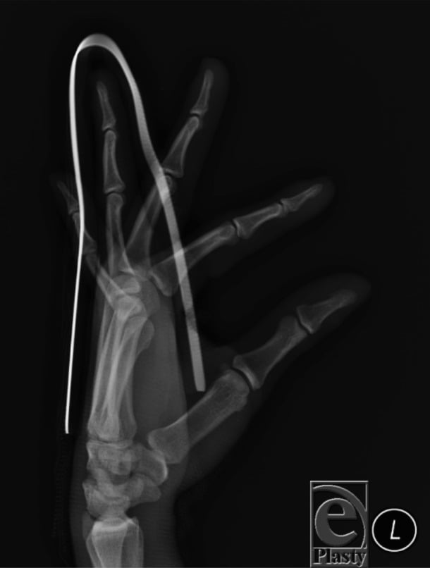 Post-reduction radiograph of a PIP dislocation with the injured finger protected in an extension splint.