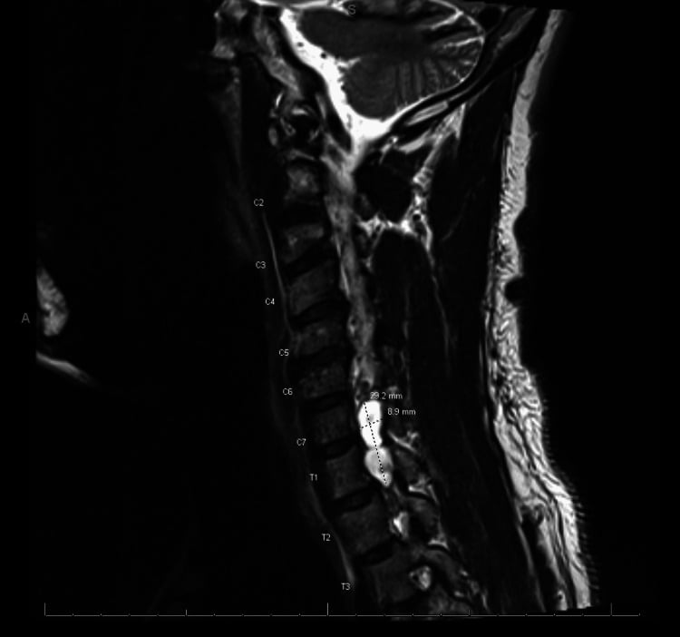 Sagittal cervical MRI with the vertebral levels labelled C2 to T3 and callipers on a bright fluid collection at the C7 to T1 levels measuring 29.2 mm by 8.9 mm.