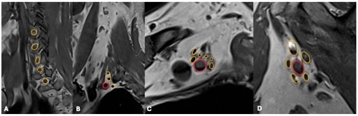 Four-panel MRI series of the brachial plexus, A to D, with the nerve elements ringed in yellow and an accompanying vessel ringed in red on the later panels.