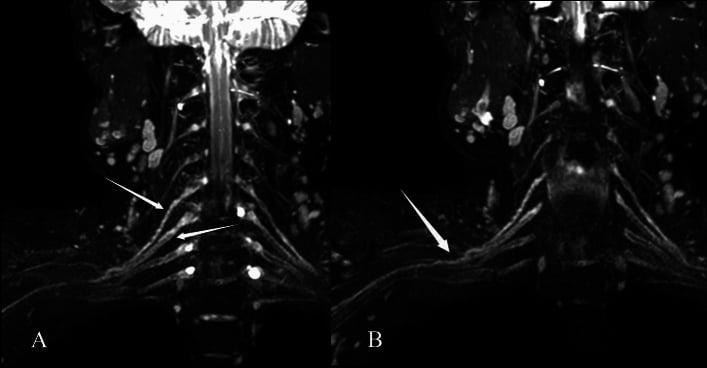 Two-panel coronal 3D SHINKEI MR neurography of the neck; arrows mark thickened, hyperintense C5-C6 postganglionic segments and the upper trunk after trauma.